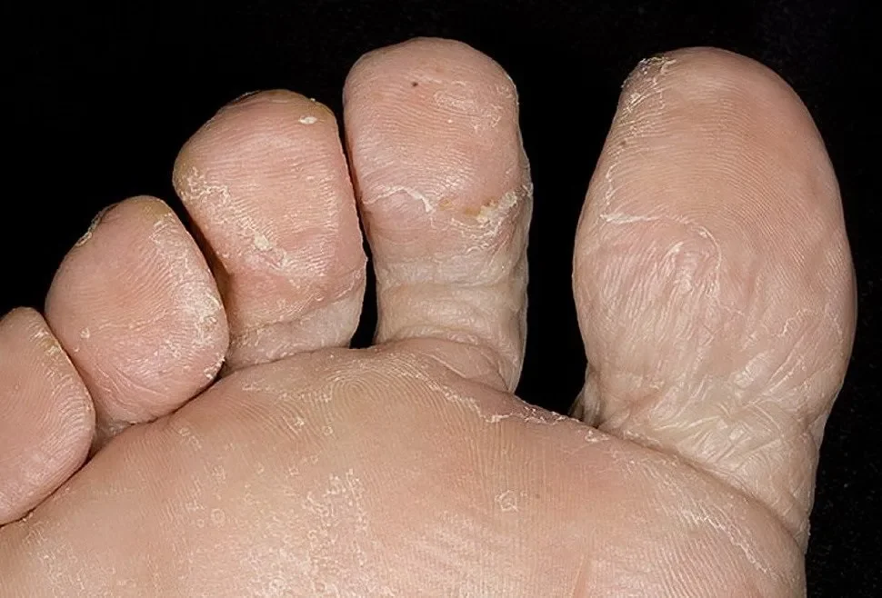 photo: Exofeet oil - fórum - hozzászólások - értékelés - teszt - vélemények